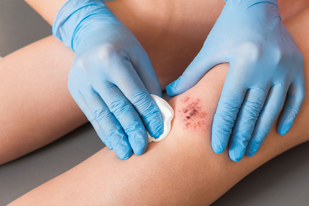 SLU-PP-332 Wound healing | Shaanxi BLOOM Tech Co., Ltd